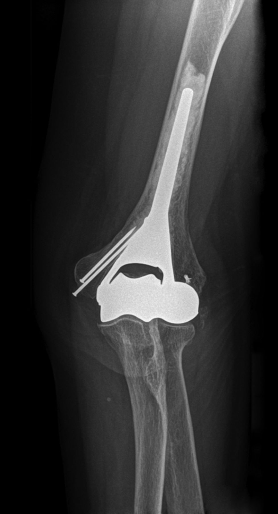 Hemiarthroplasty for irreparable distal humeral fractures | Bone & Joint