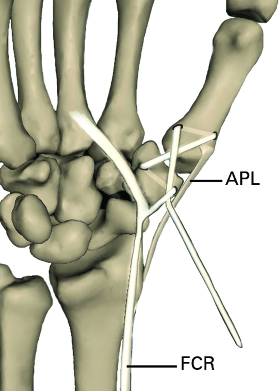 An alternative technique for stabilisation of the carpometacarpal joint ...