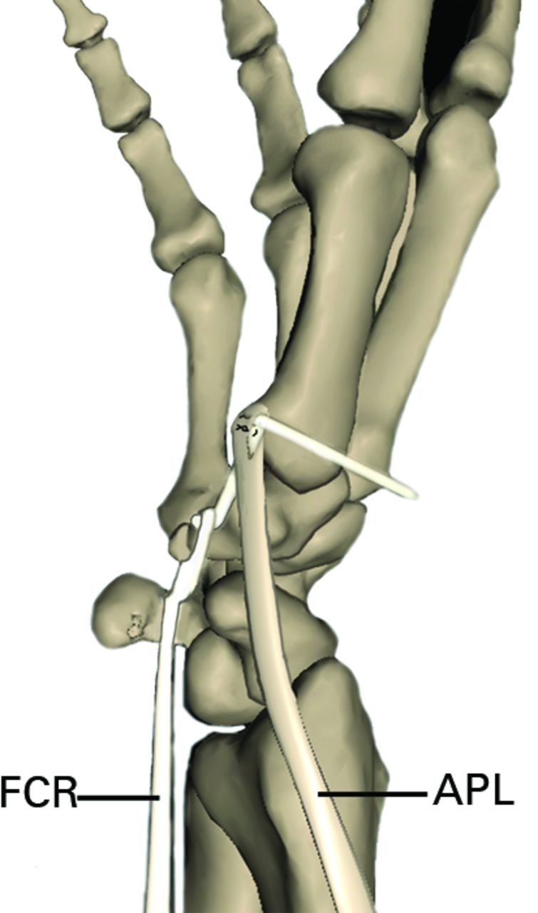 An alternative technique for stabilisation of the carpometacarpal joint ...