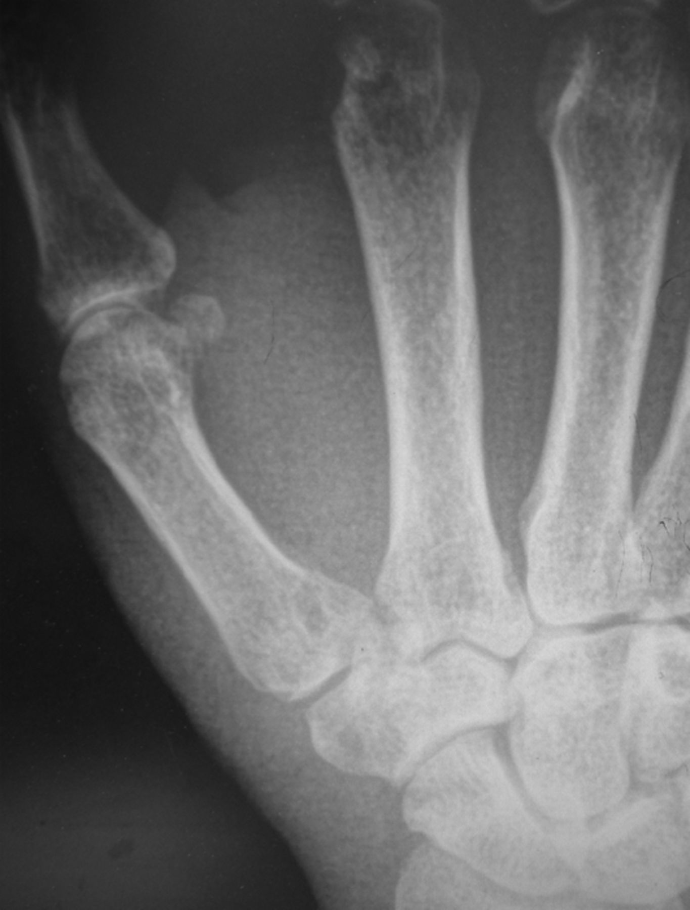 carpometacarpal joint dislocation