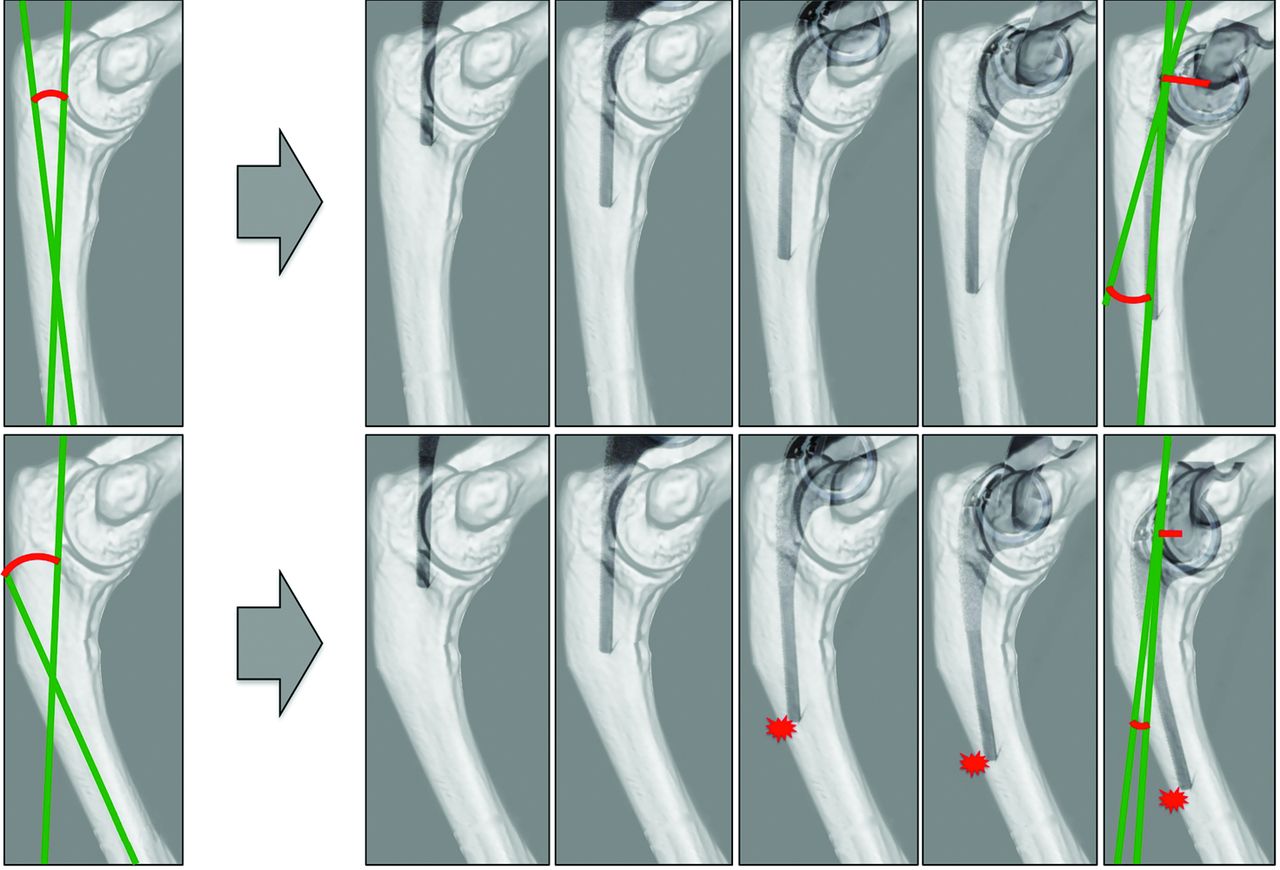 The effect of the anatomy of the distal humerus and proximal ulna on ...