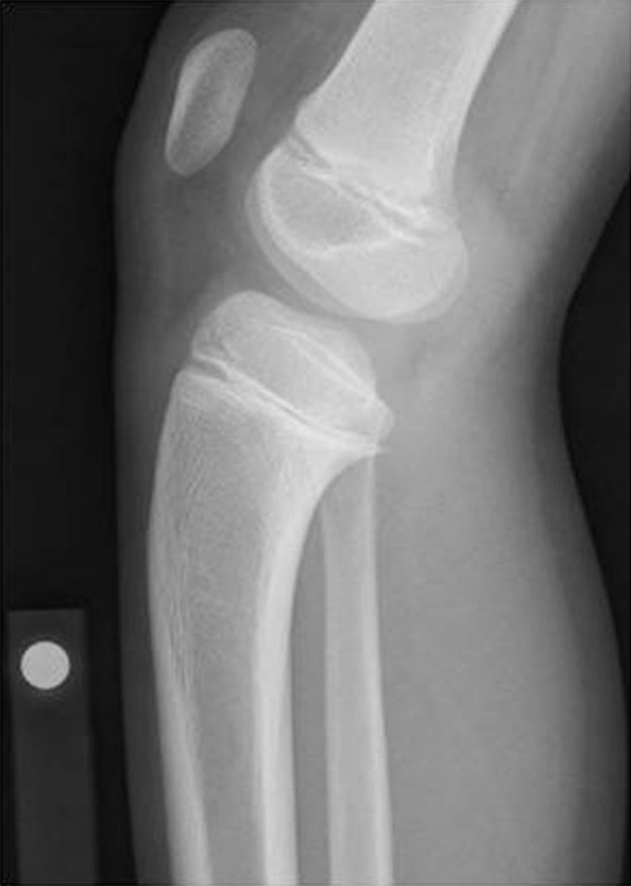 Resection of a physeal bar with complete transverse osteotomy at the ...