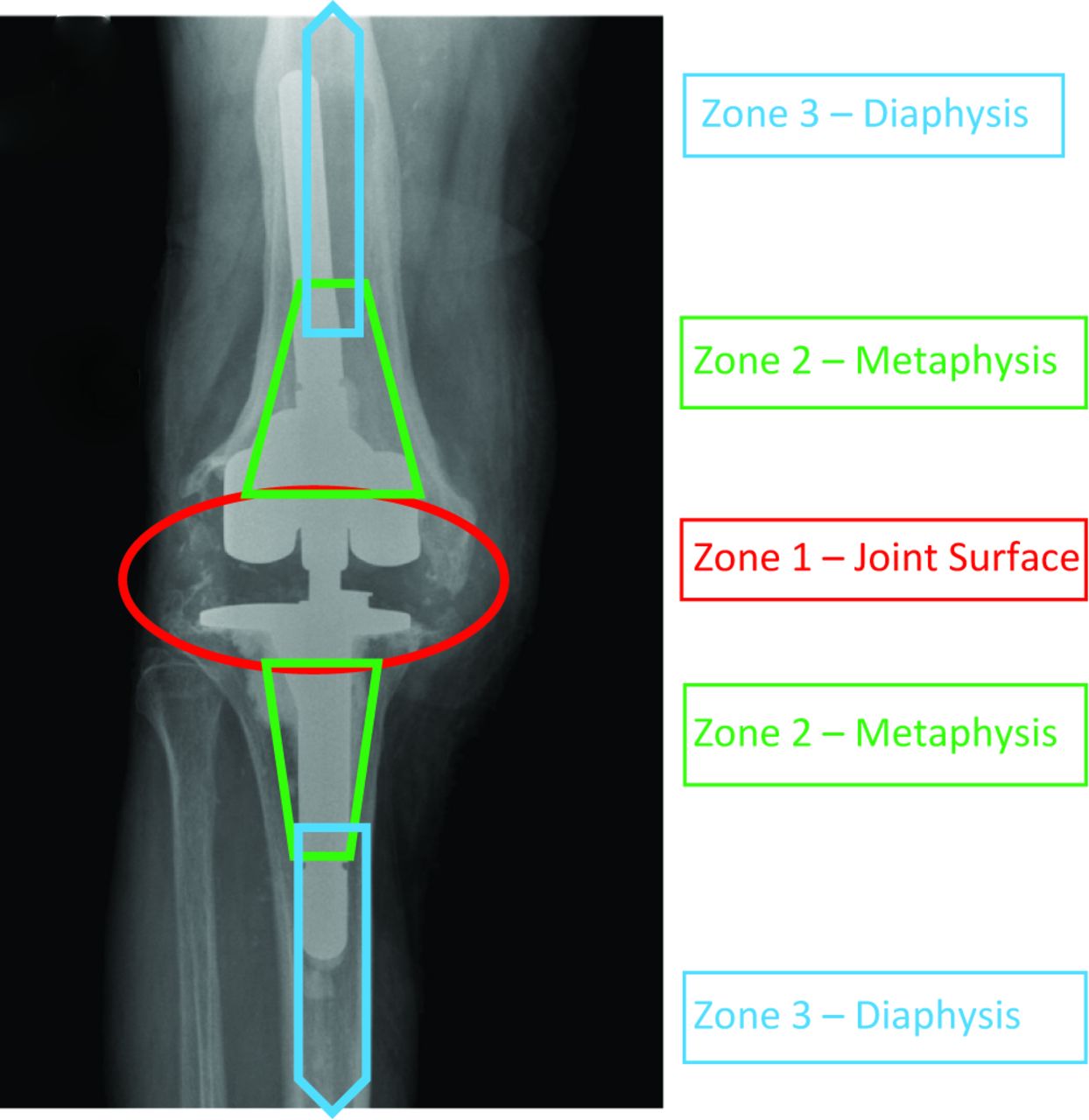 Zonal Fixation In Revision Total Knee Arthroplasty Bone And Joint