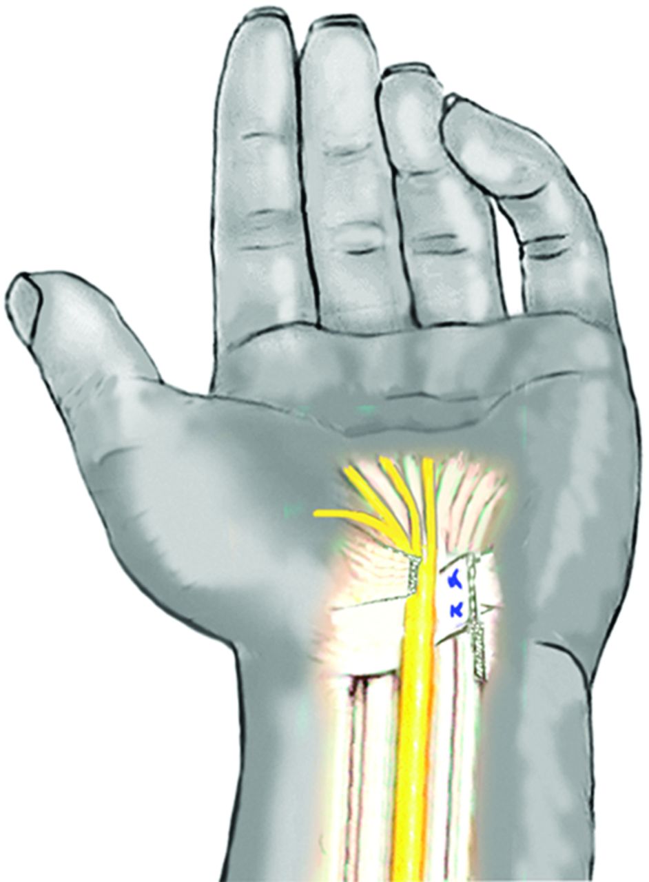 Carpal tunnel release with subneural reconstruction of the transverse ...