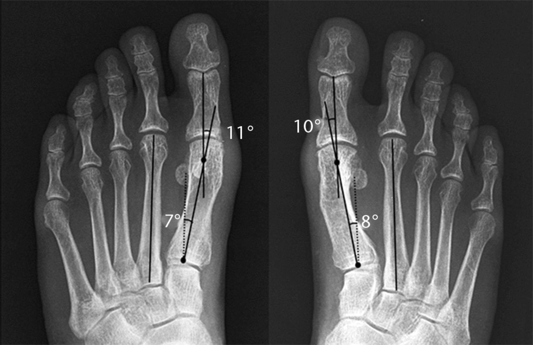 A Comparison Of Proximal And Distal Chevron Osteotomy, Both With ...