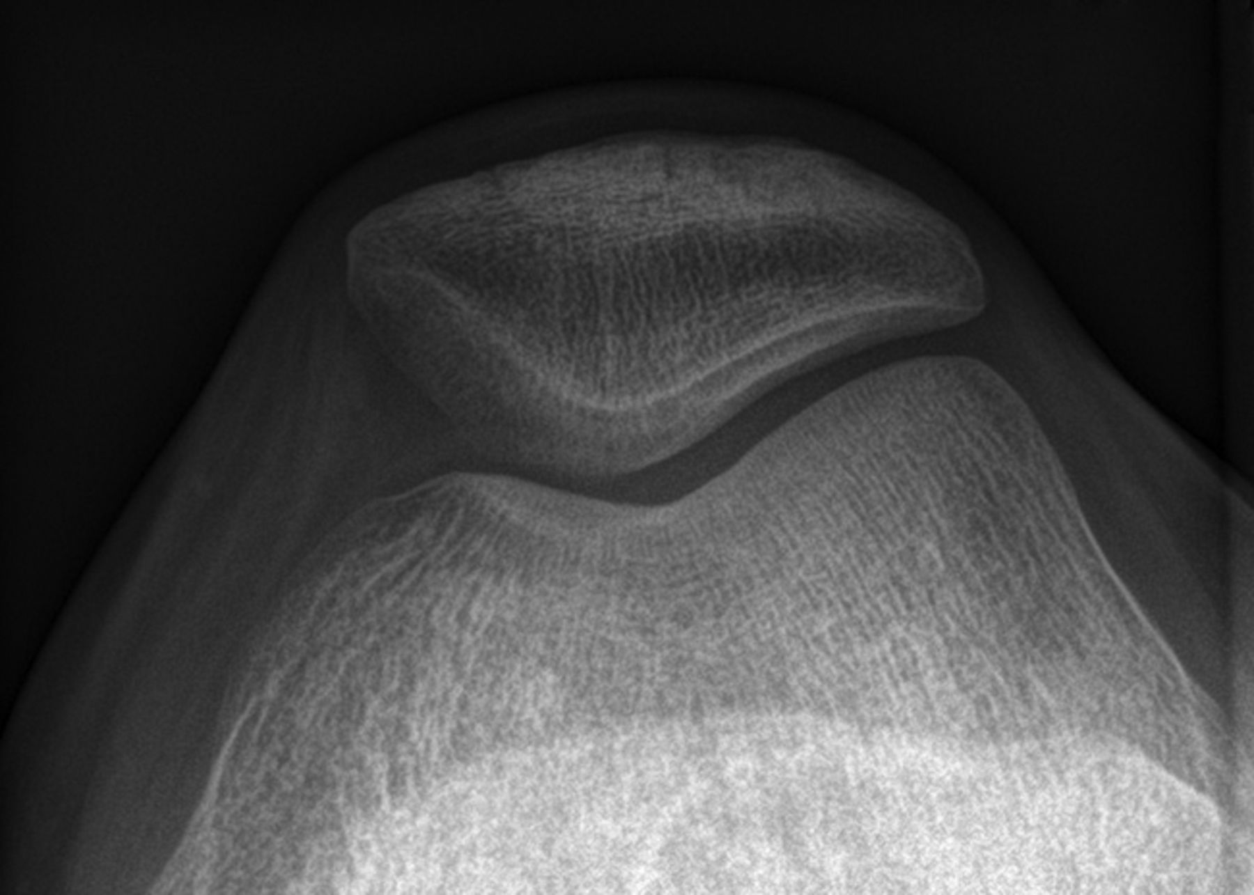 A self-centring osteotomy of the tibial tubercle for patellar ...