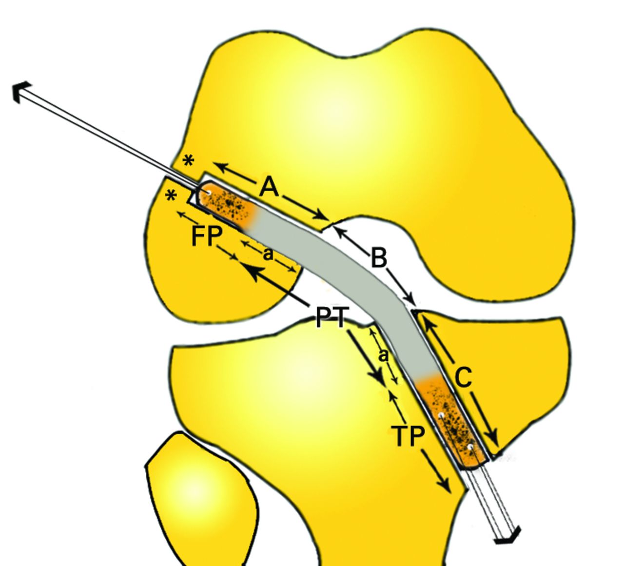 Prevention Of Graft-tunnel Mismatch During Anatomical Anterior Cruciate ...