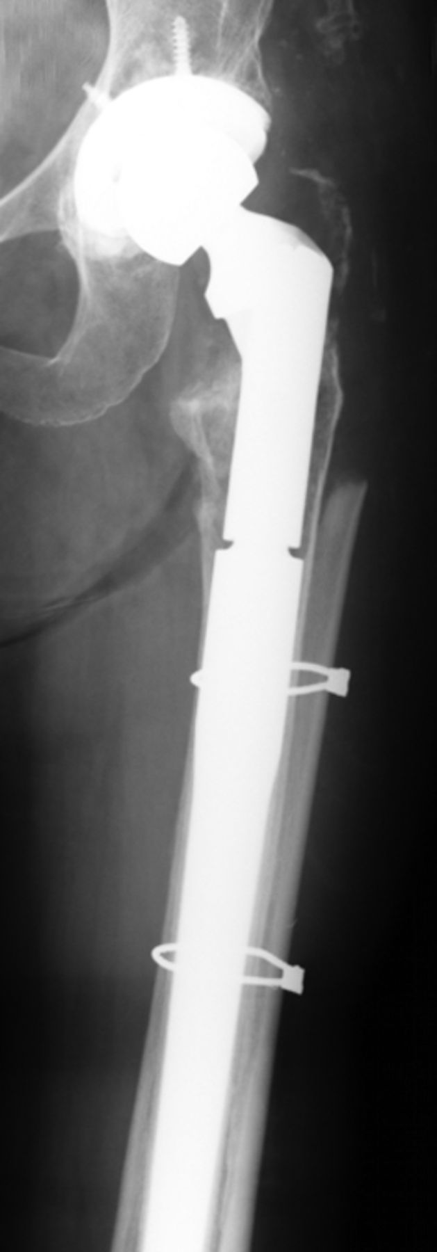 Revision Total Hip Arthroplasty In Patients With Extensive Proximal ...