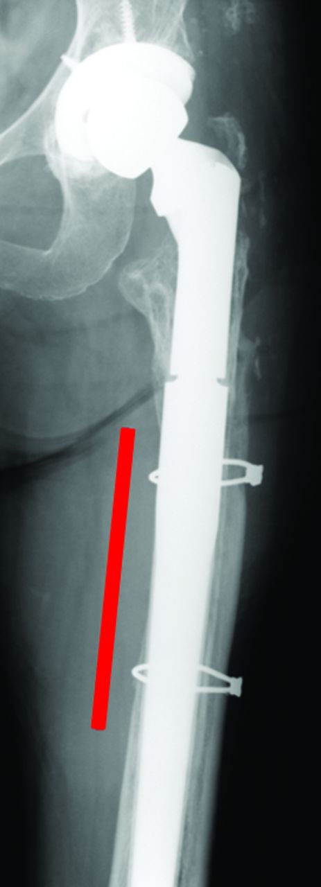 Revision Total Hip Arthroplasty In Patients With Extensive Proximal Femoral Bone Loss Using A 5020