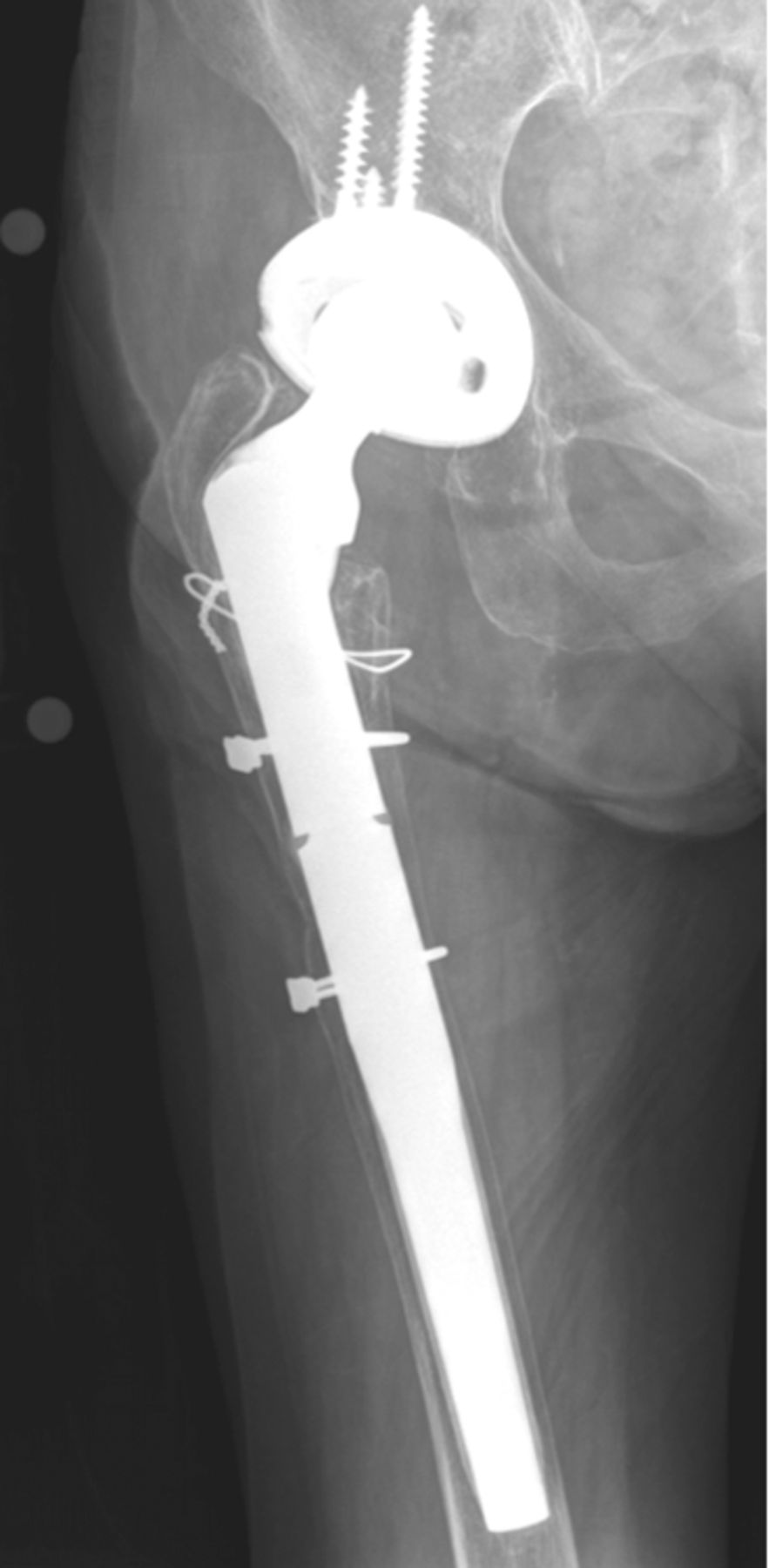 Revision Total Hip Arthroplasty In Patients With Extensive Proximal Femoral Bone Loss Using A 0083