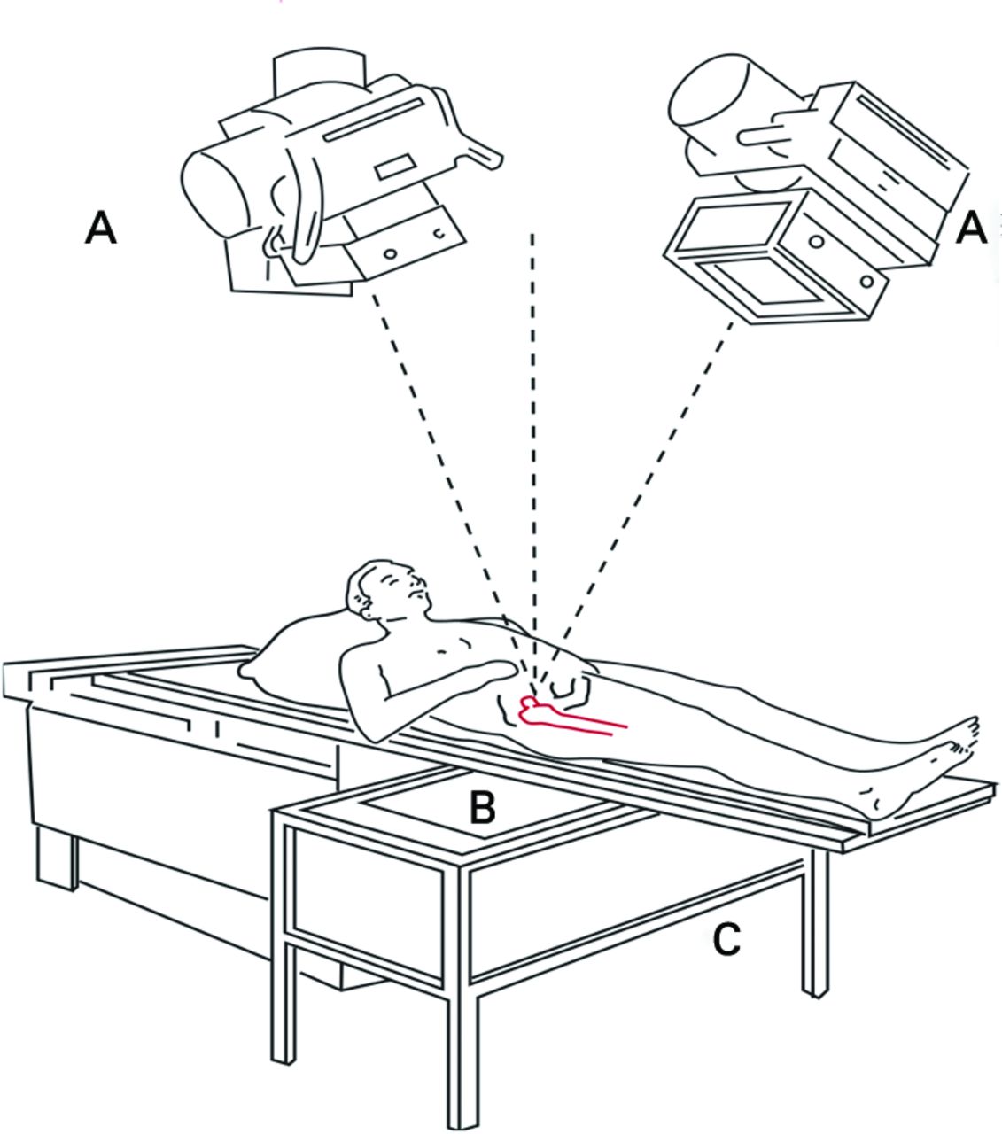 The stability of fixation of proximal femoral fractures | Bone & Joint