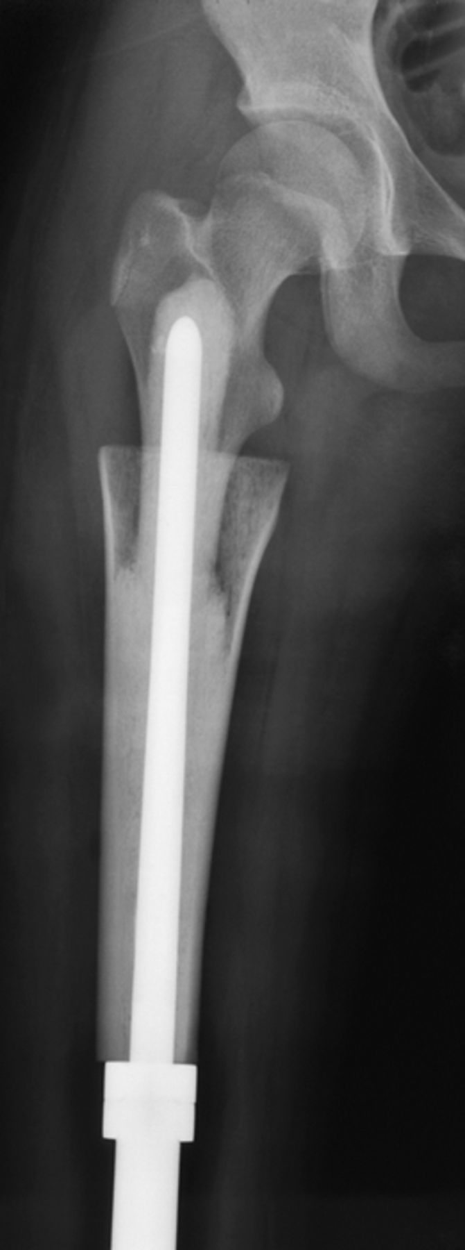 Cortical Strut Bone Grafting And Long Stem Endoprosthetic
