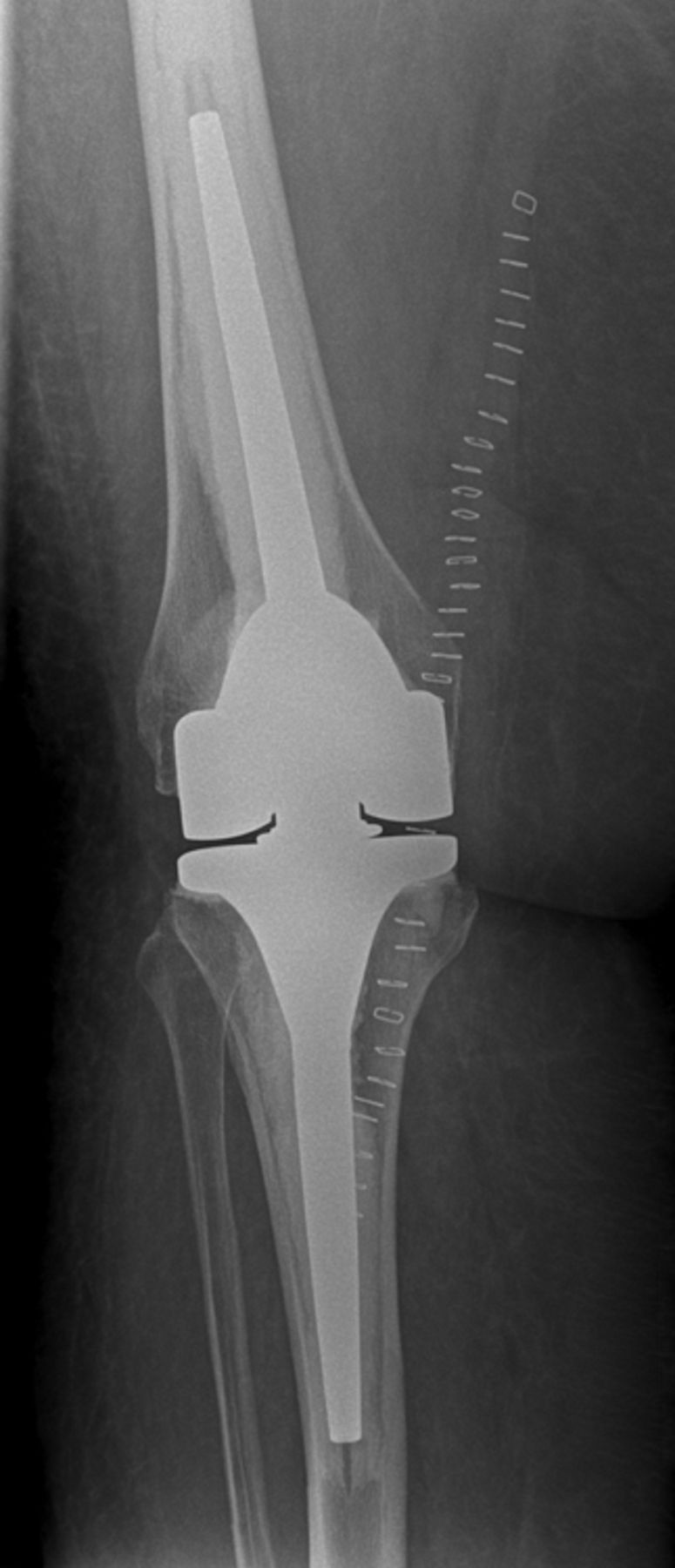 Septic Single-stage Knee Arthrodesis After Failed Total Knee 