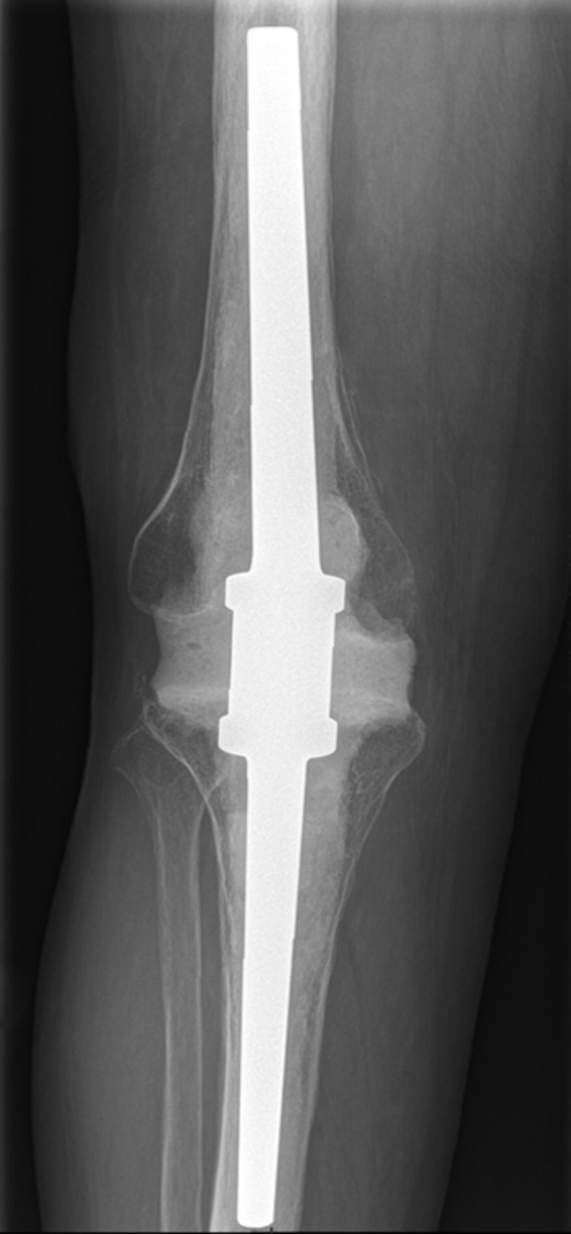 Septic single-stage knee arthrodesis after failed total knee ...