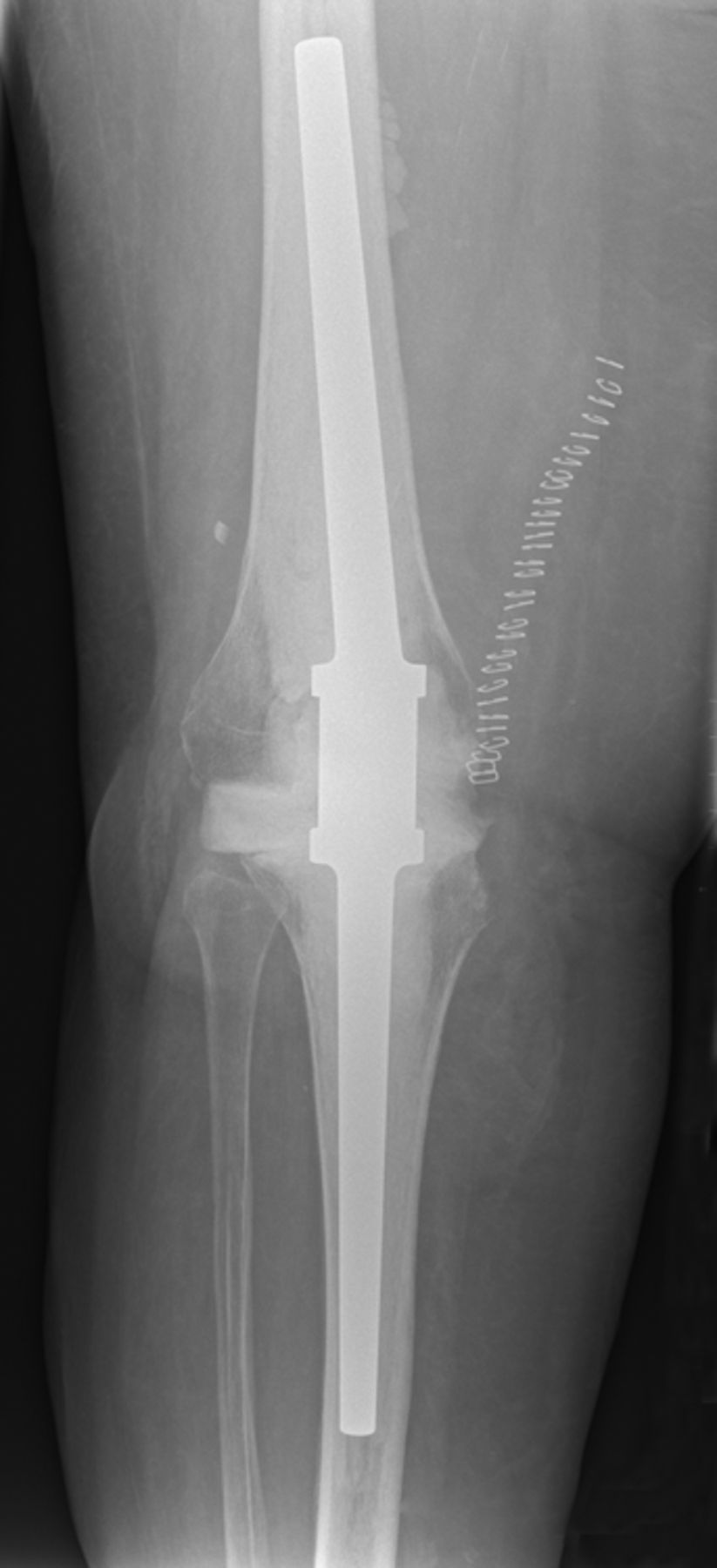 Septic Single-stage Knee Arthrodesis After Failed Total Knee 