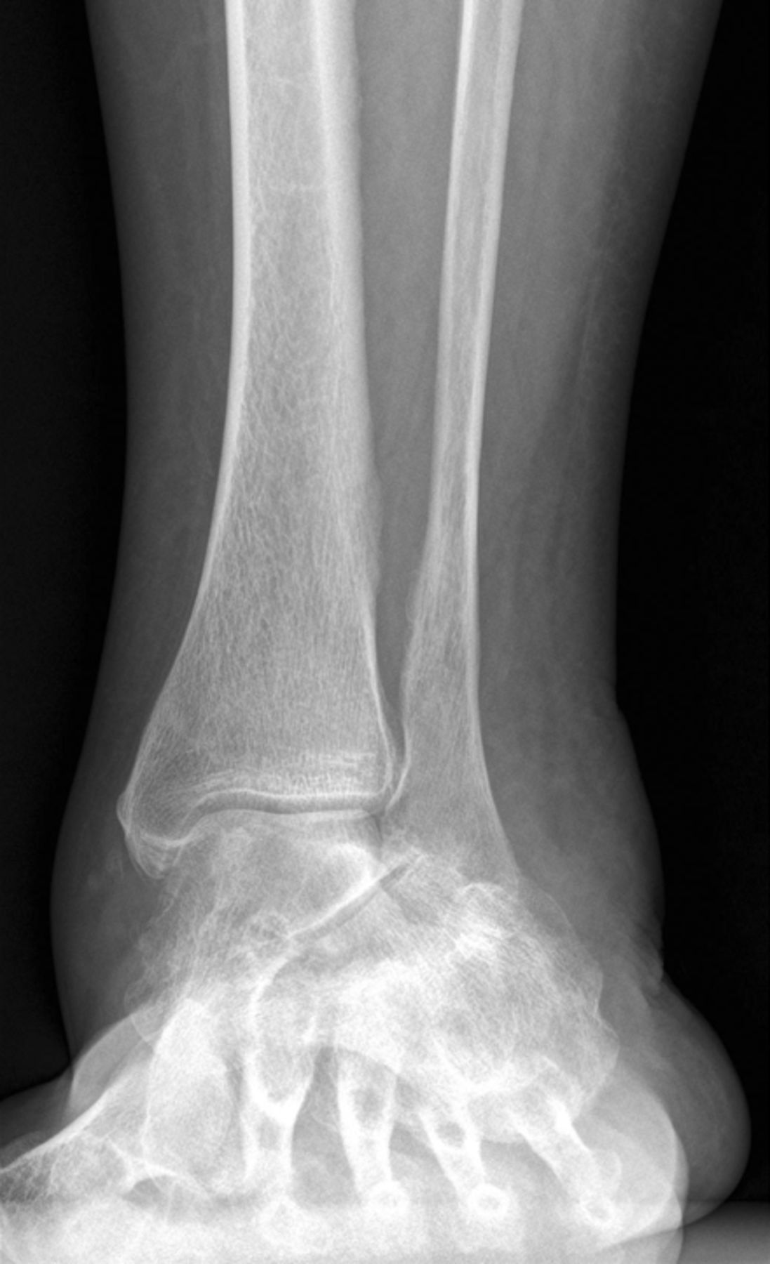 Mid- to long-term outcome of 96 corrective hindfoot fusions in 84 ...