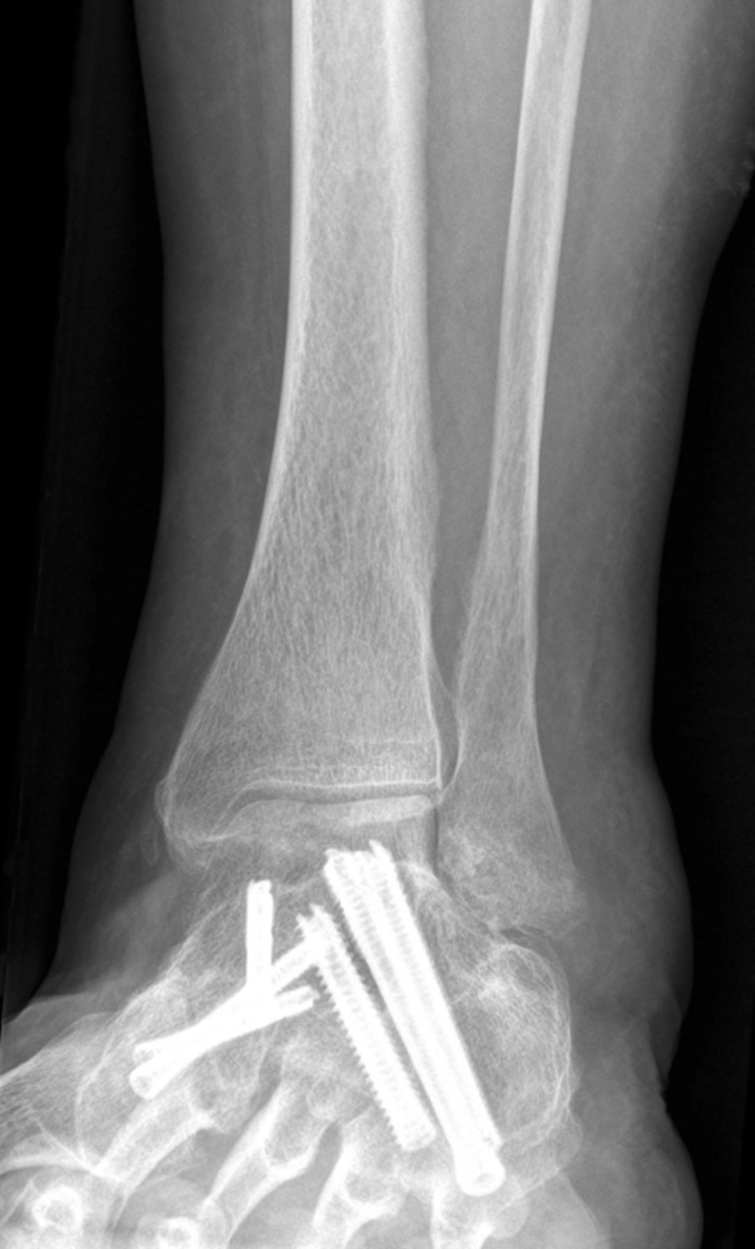 Mid- to long-term outcome of 96 corrective hindfoot fusions in 84 ...