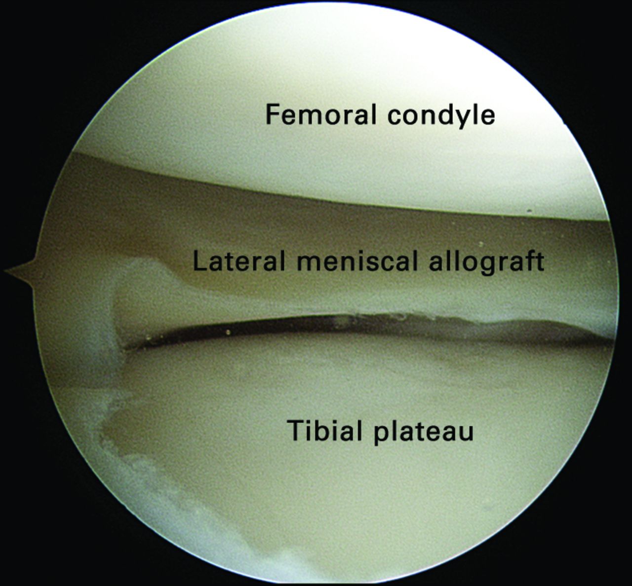 Meniscal Allograft Transplantation | Bone & Joint