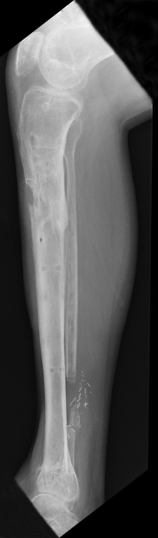 Management Of Infected Nonunion Of The Long Bones By A ...