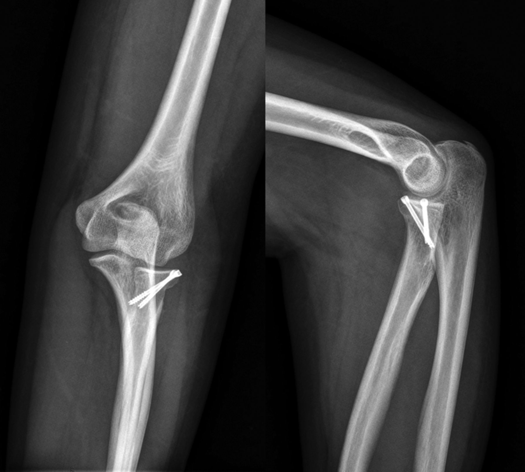 Is Cross Screw Fixation Superior To Plate For Radial Neck Fractures   34868 Galleyfig2b 