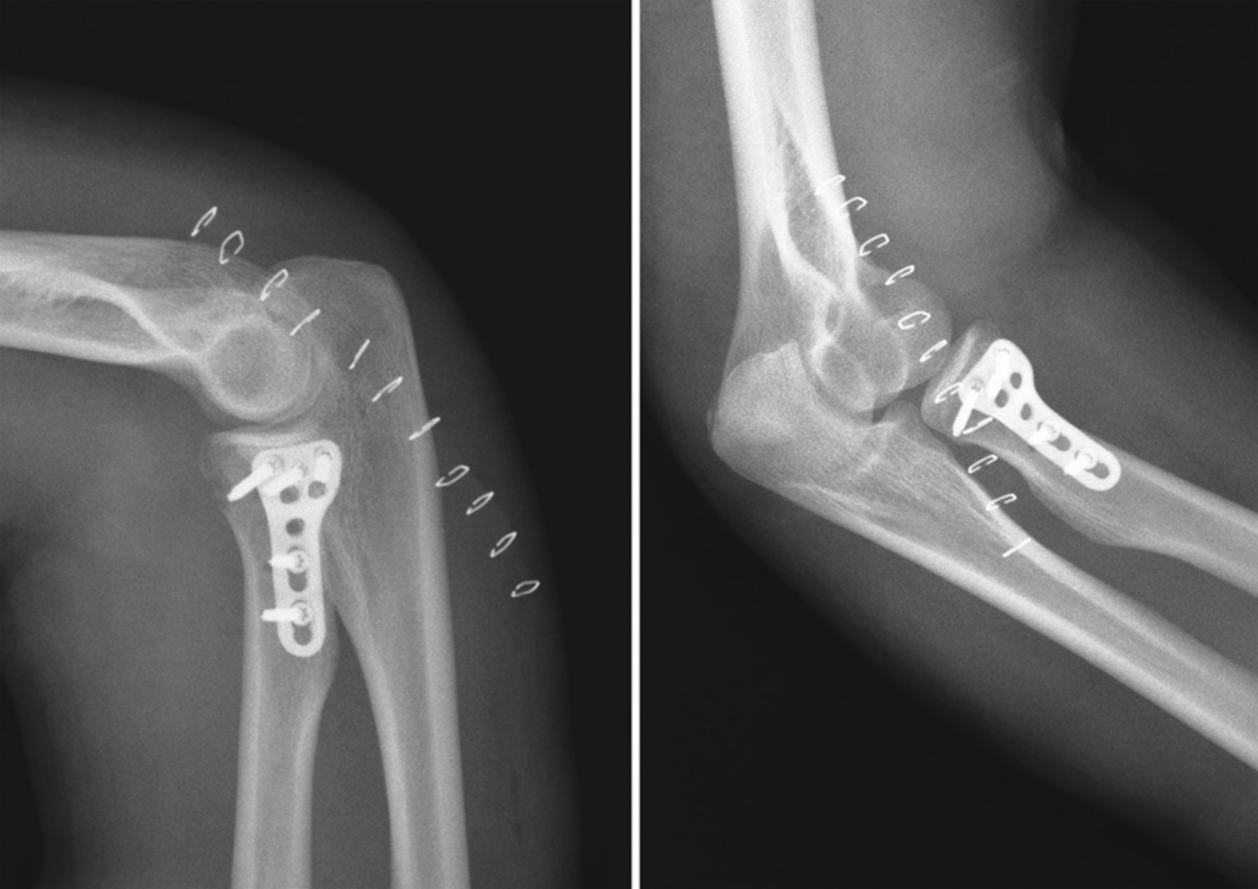 Radial Head Fracture Fixation Arm Docs - vrogue.co