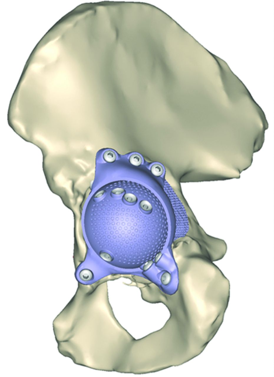 The accuracy of positioning of a custom-made implant within a large ...