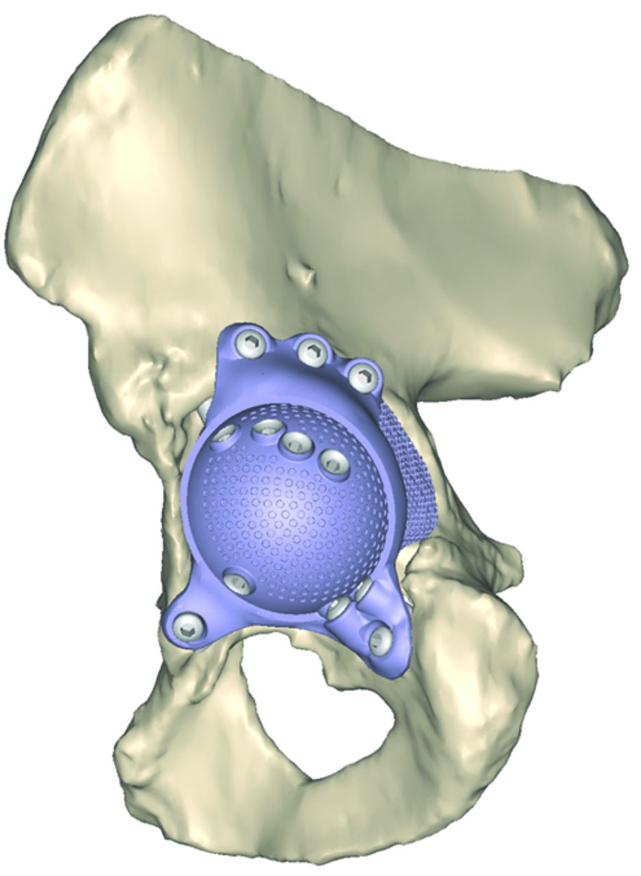 The Accuracy Of Positioning Of A Custom-made Implant Within A Large ...