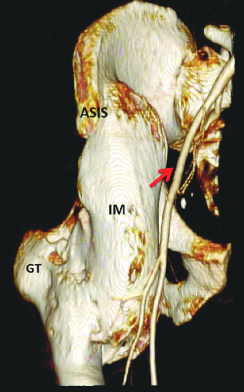 A New Classification Of Peri Articular Heterotopic Ossification Of The Hip Associated With