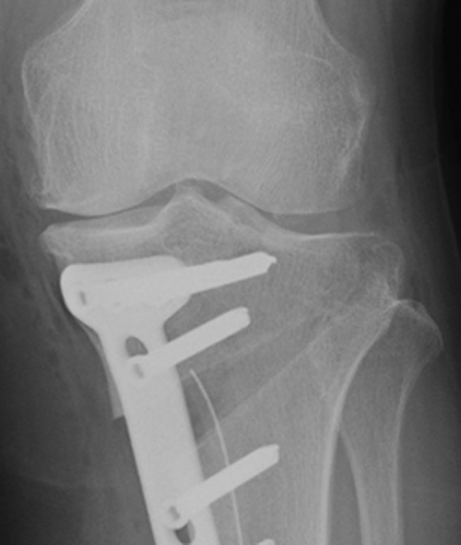 The validity of the classification for lateral hinge fractures in open ...