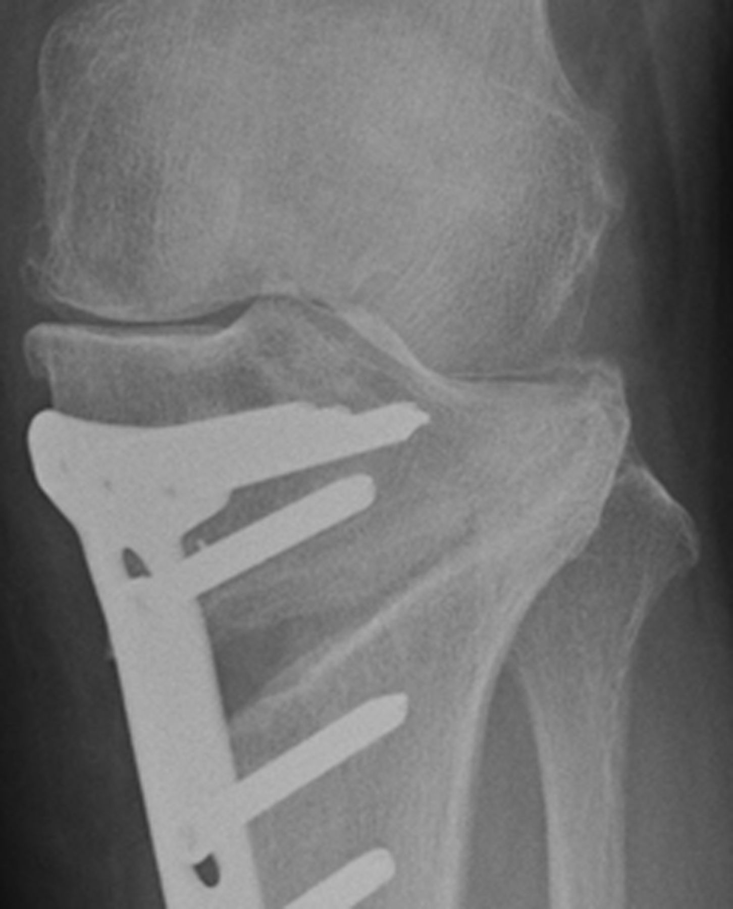 The Validity Of The Classification For Lateral Hinge Fractures In Open ...