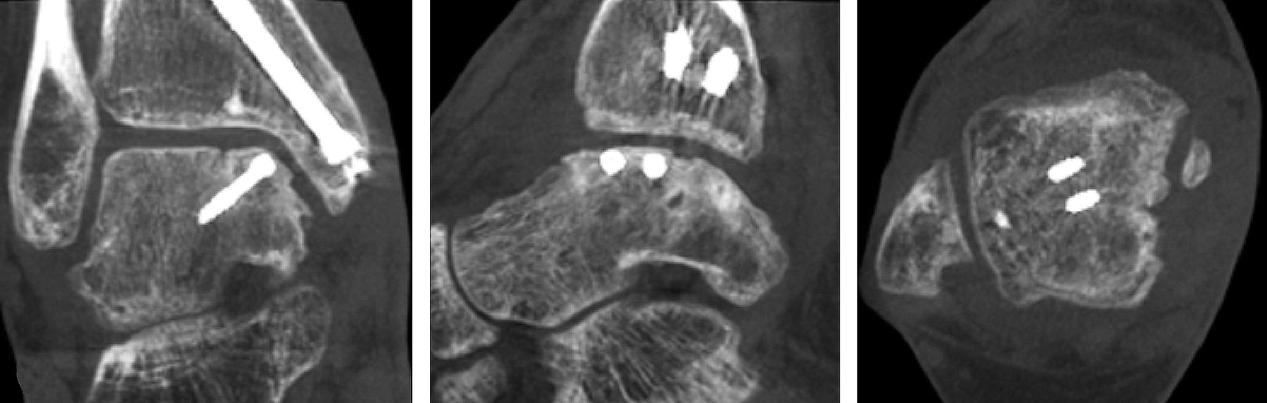 Treatment Of Extended Osteochondral Lesions Of The Talus With A Free ...