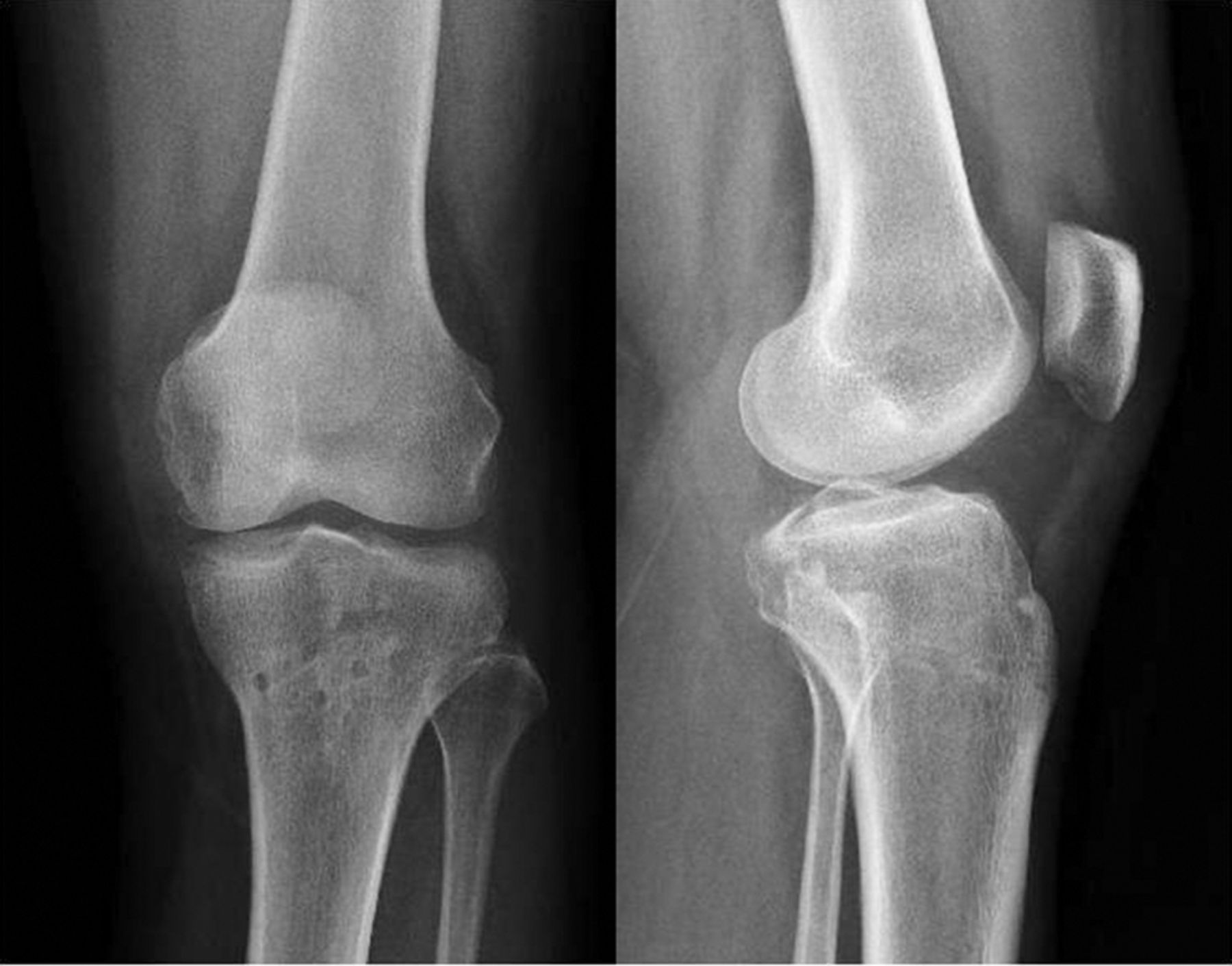 Arthroscopic fixation of an avulsion fracture of the tibia involving ...