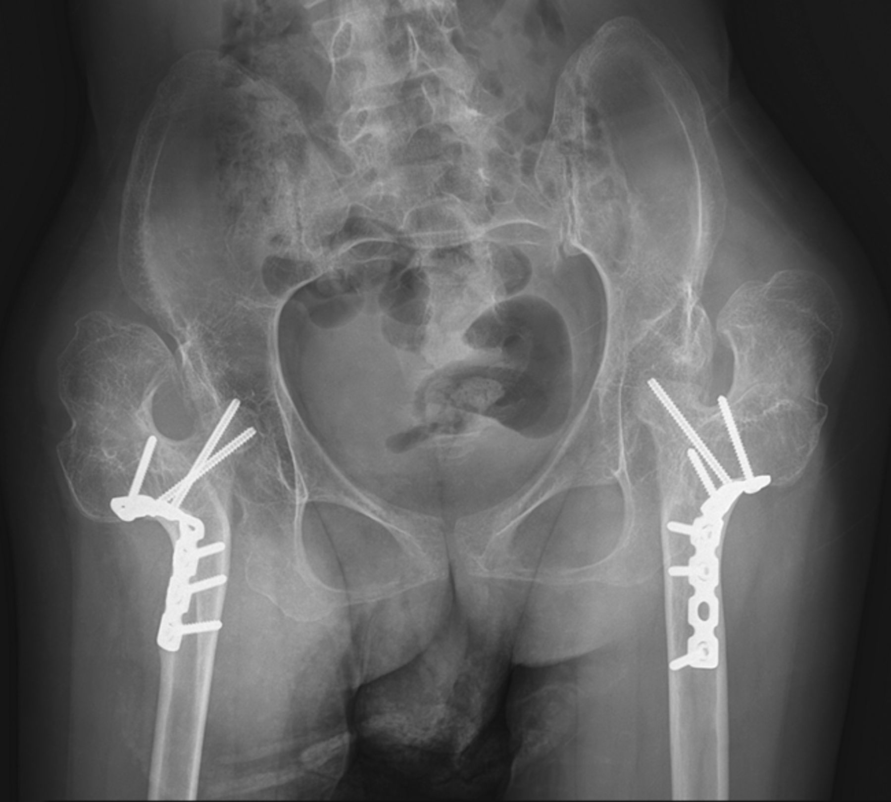 Salvage procedures for the painful chronically dislocated hip in ...