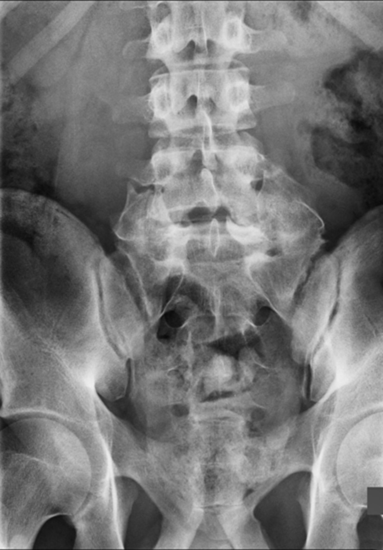 Radiographic and functional outcome of posterolateral lumbosacral ...