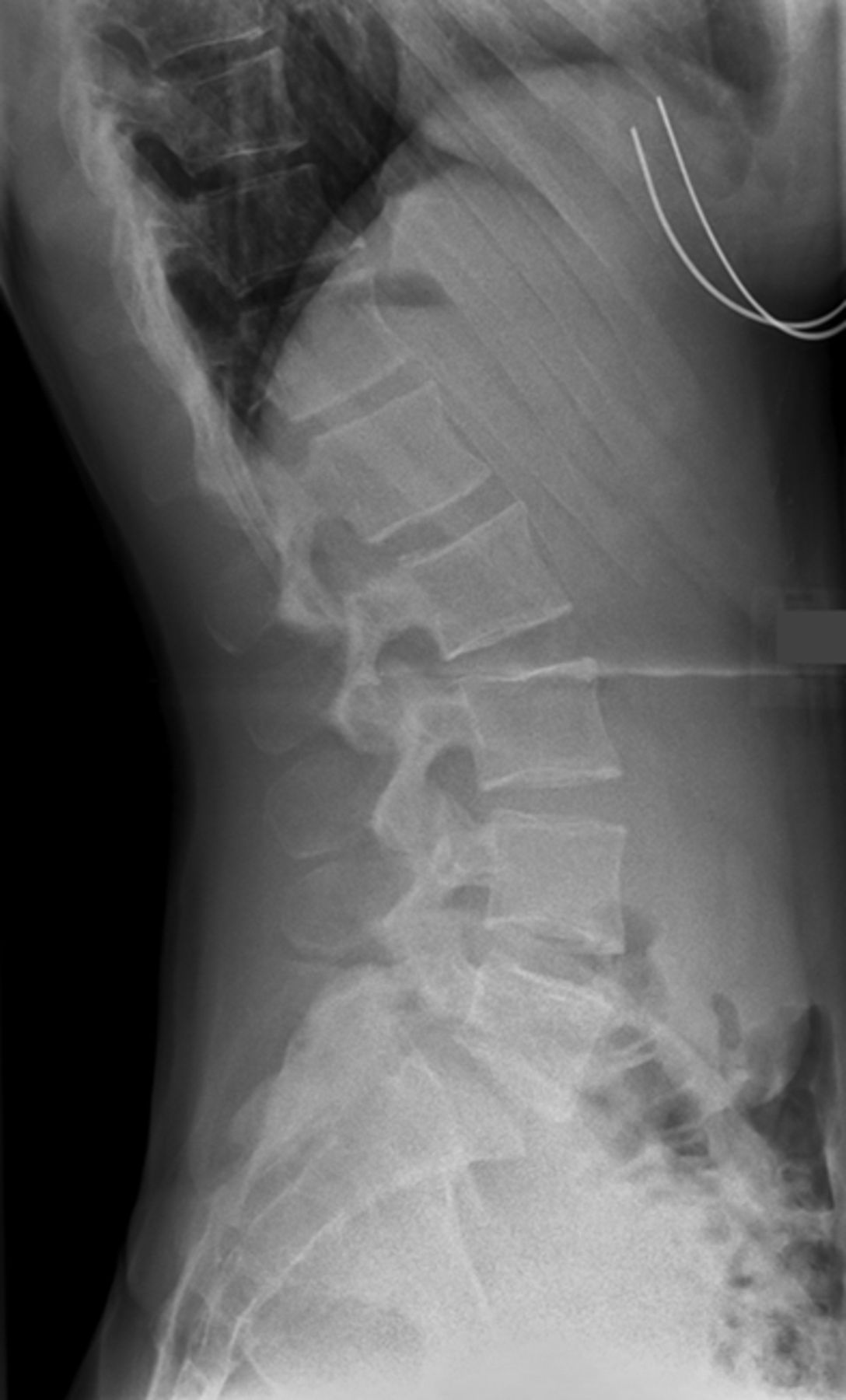 Radiographic And Functional Outcome Of Posterolateral Lumbosacral ...