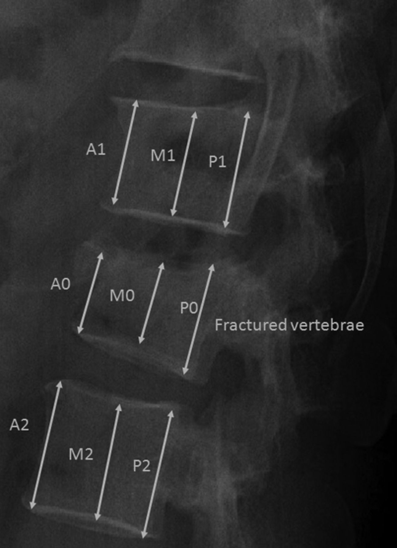 Is Removal Of The Implants Needed After Fixation Of Burst Fractures Of ...