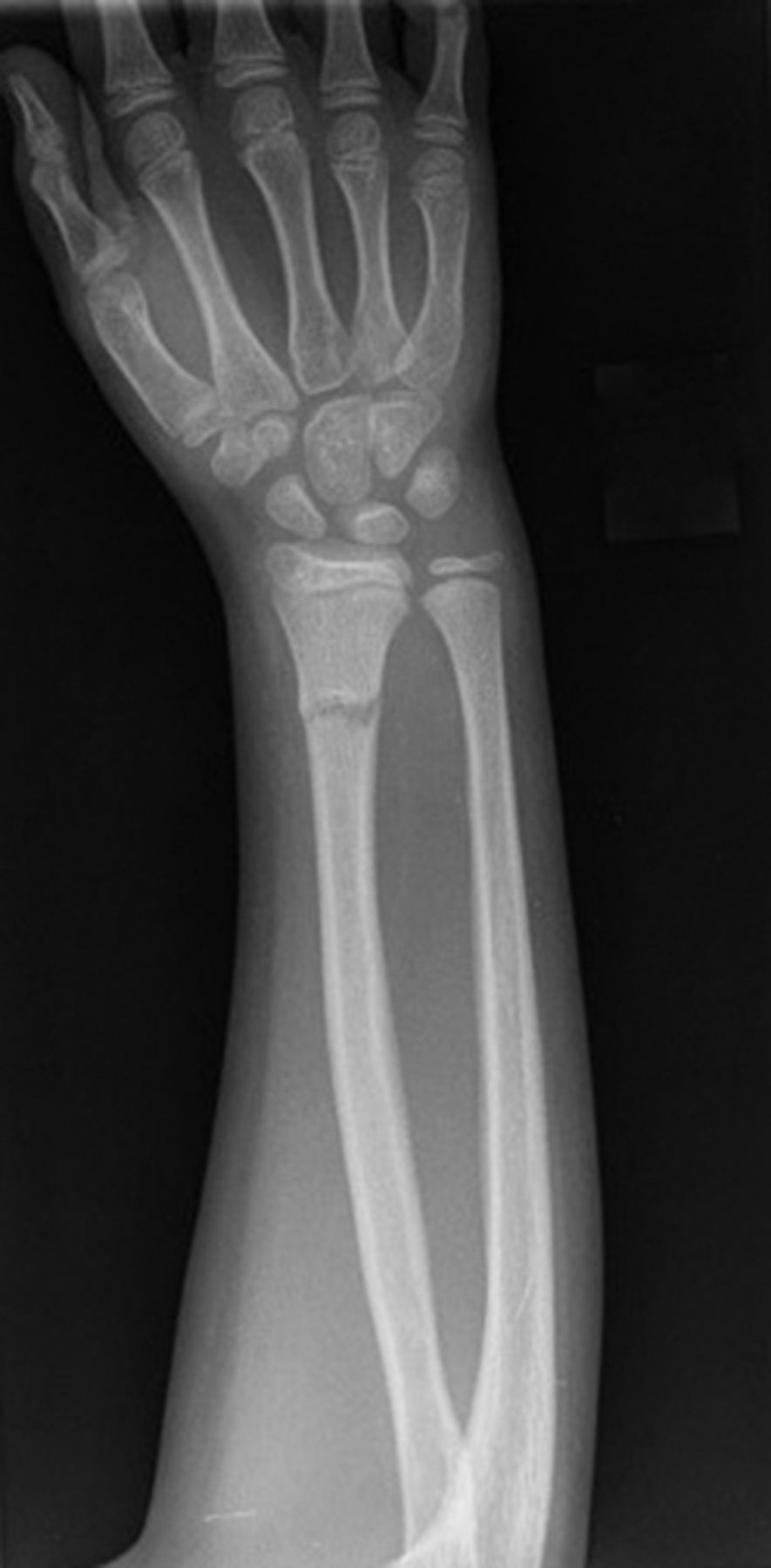 Manipulation And Reduction Of Paediatric Fractures Of The Distal Radius