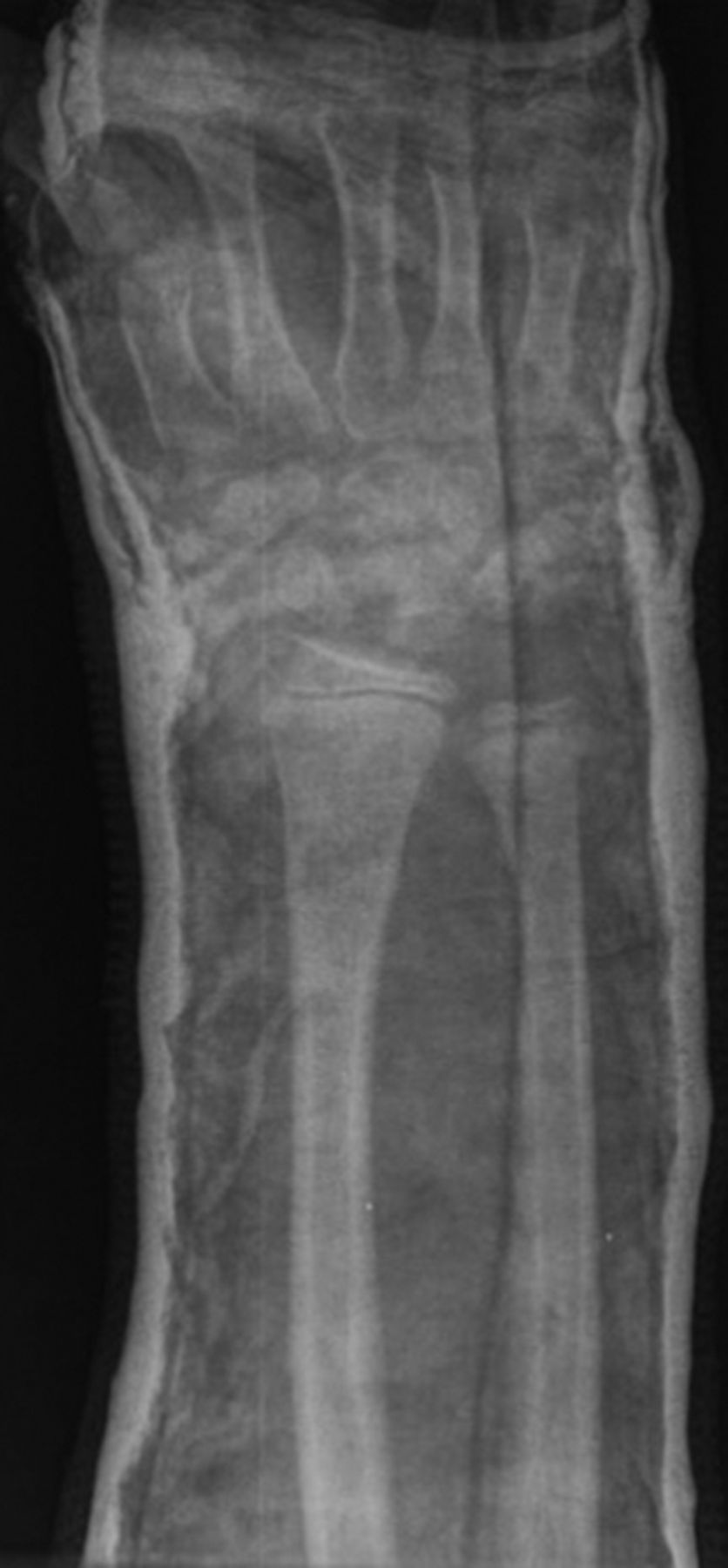 Manipulation And Reduction Of Paediatric Fractures Of The Distal Radius