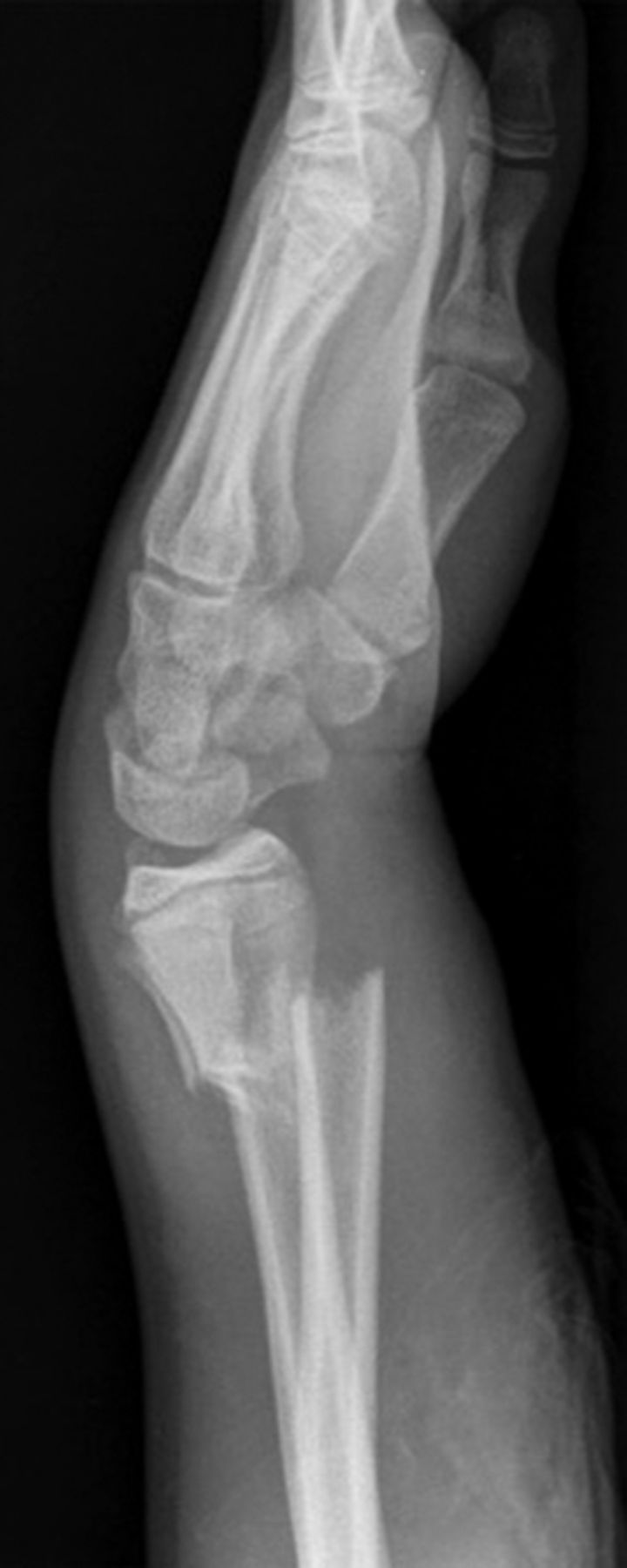 Manipulation And Reduction Of Paediatric Fractures Of The Distal Radius