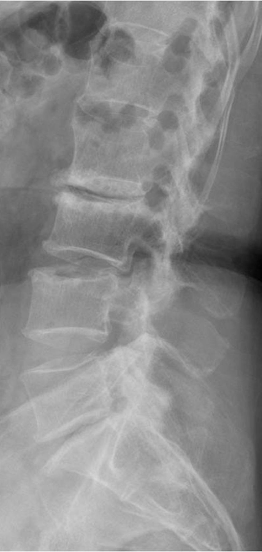 The outcomes of instrumented posterolateral lumbar fusion in patients ...