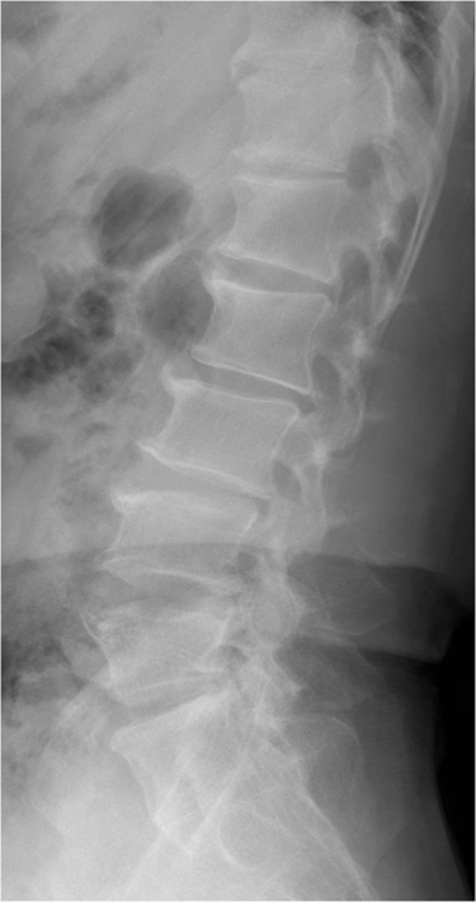 The outcomes of instrumented posterolateral lumbar fusion in patients ...