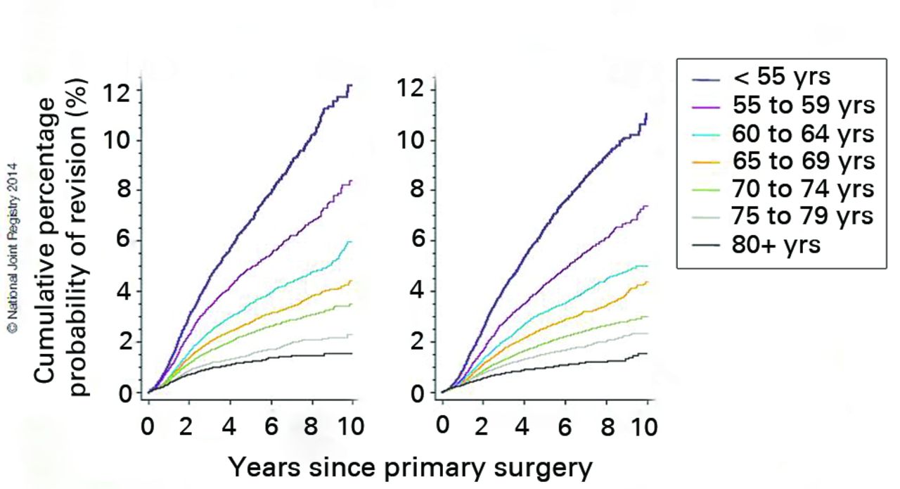 Fig. 2 
            Kaplan–Meier estimates of the cumulative
percentage probability of a first revision of primary knee arthroplasty
broken down by age group and gender at increasing years after primary
surgery. (Reproduced with permission from NJR England Wales Northern
Ireland, Annual Report 2014).
          