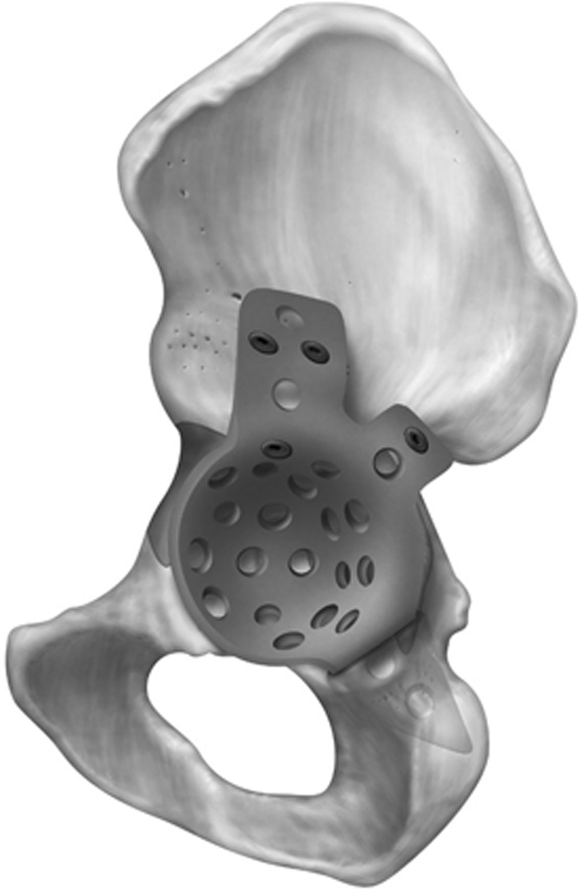 The role of cages in the management of severe acetabular bone defects ...