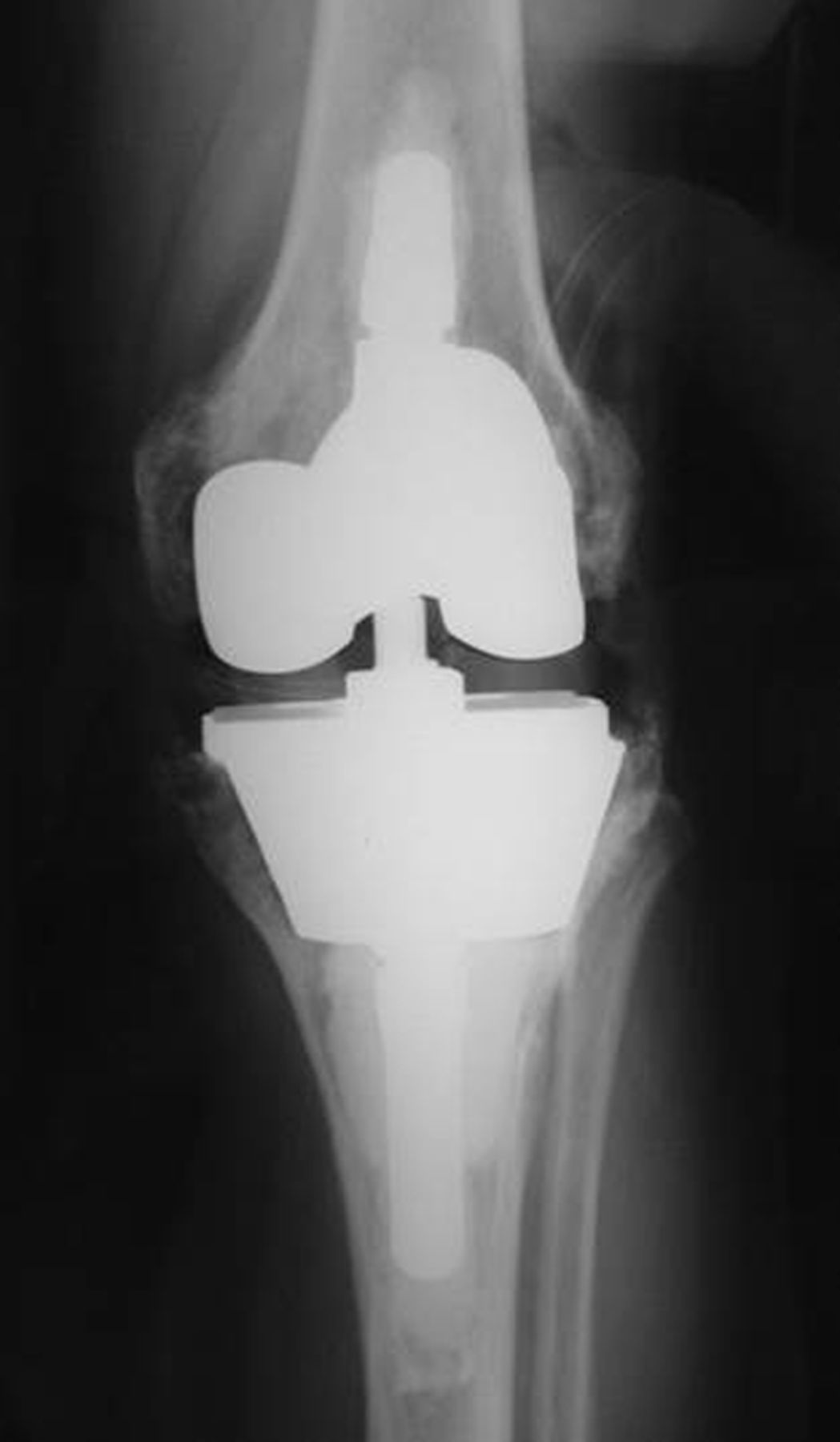 The management of bone loss in revision total knee arthroplasty | Bone ...