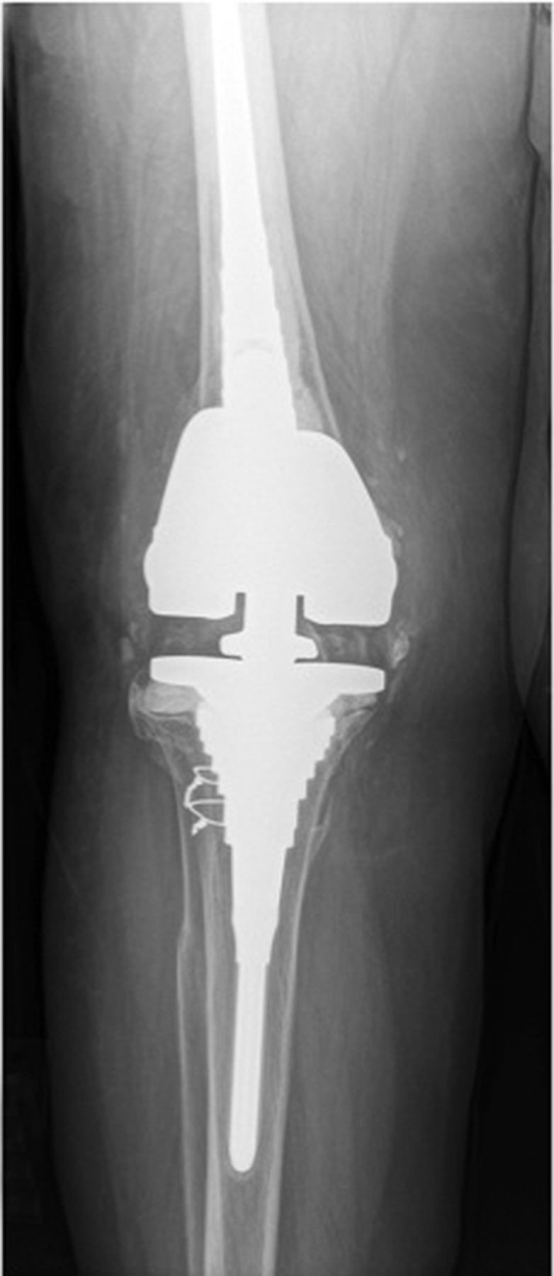 Instability In Total Knee Arthroplasty 