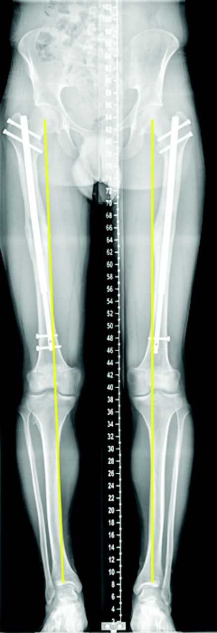 Figs. 1a - 1b 
          a) Radiographs of a 17-year old
male patient with short stature due to Léri-Weill dyschondrosteosis.
An anteroposterior (AP) whole leg alignment view pre-lengthening
demonstrating the mechanical axis. b) AP whole leg alignment view post-lengthening
of 65 mm of both femurs performed sequentially demonstrating no
marked change in the mechanical axis of either limb.
        