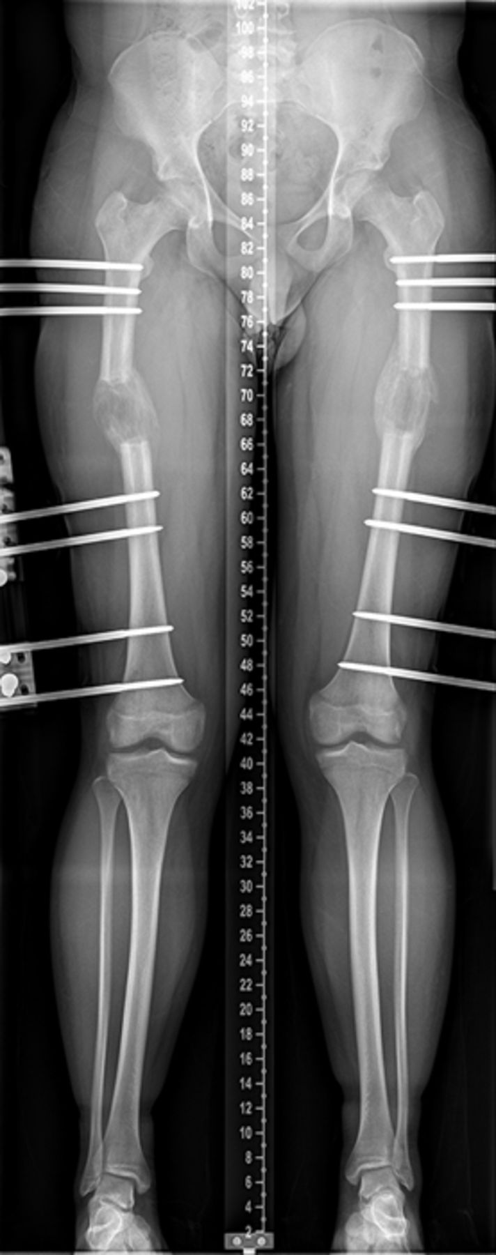 Fig. 2 
          An anteroposterior whole leg alignment
radiograph of an 18-year old male patient with short stature during
the consolidation phase of simultaneous bilateral femoral lengthening
of 60 mm with the use of the LRS system. It demonstrates the typical
varus angulation and translation deformity due to the cantilever
effect of the soft tissue.
        