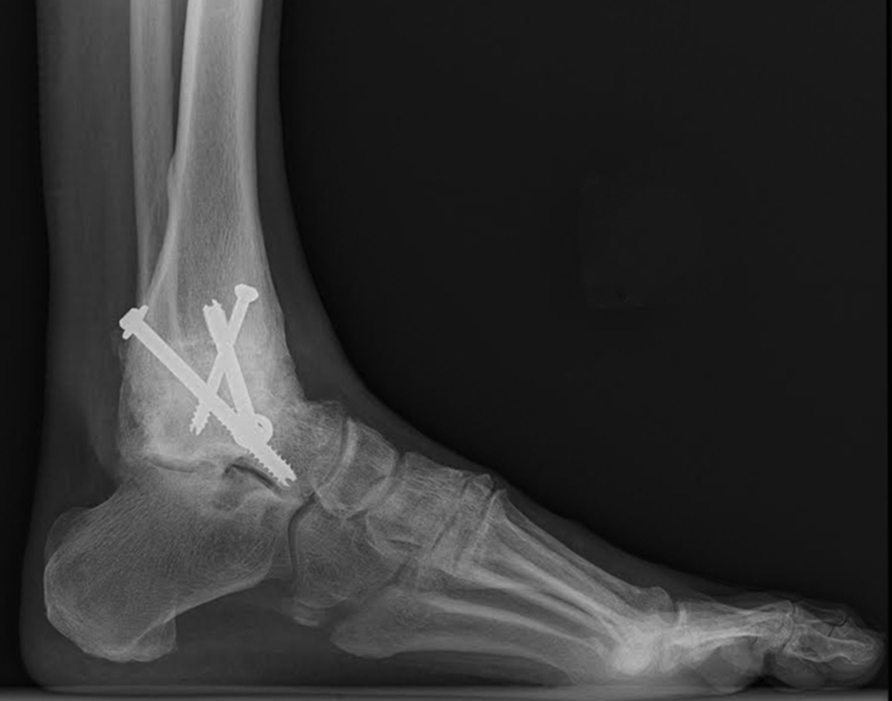 Abnormalities of gait caused by ankle arthritis are improved by ankle ...