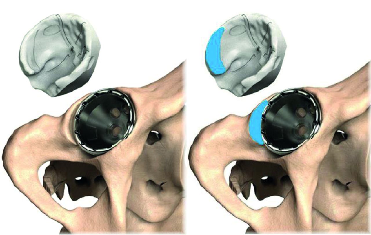 Patient Specific Instrumentation Improves The Accuracy Of Acetabular Component Placement In 1392