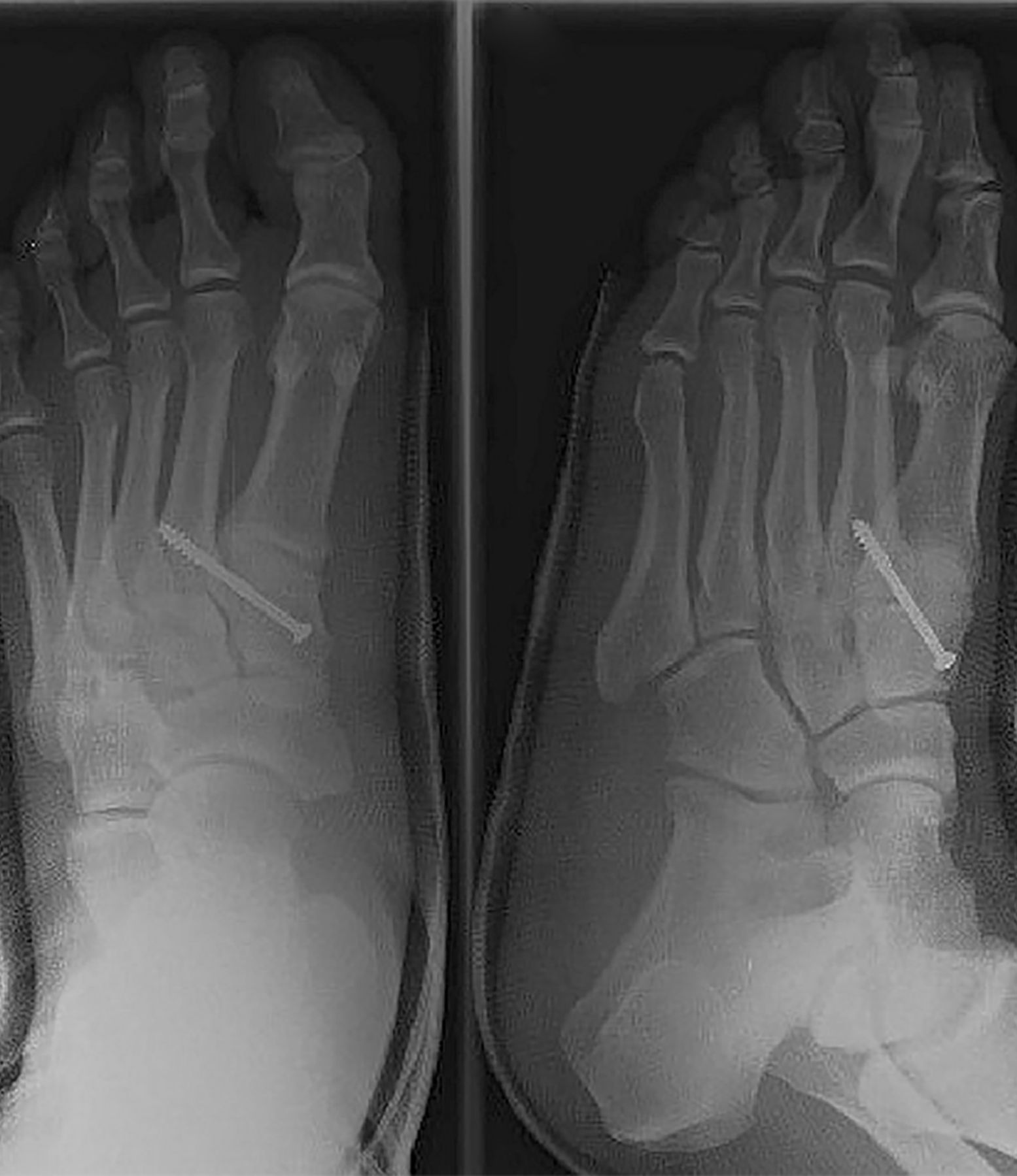 Lisfranc injury: How 5 basketball players returned after the diagnosis